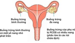 Bài thuốc trị bệnh đa nang buồng trứng