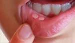 Cách đơn giản trị nhiệt miệng